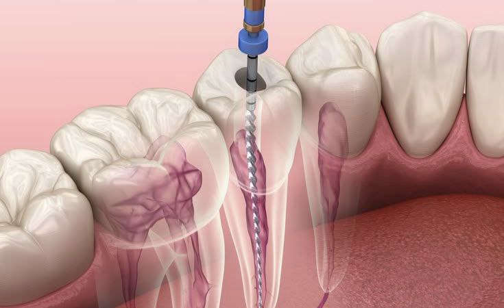 Root Canal